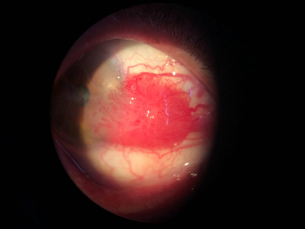 superfície ocular