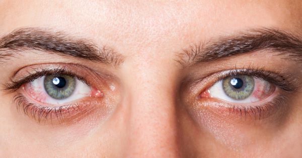 síndrome do olho seco: olhos avermelhados
