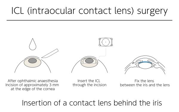 lustração de correção da visão com lentes de contato intraoculares - solução para reverter a catarata.