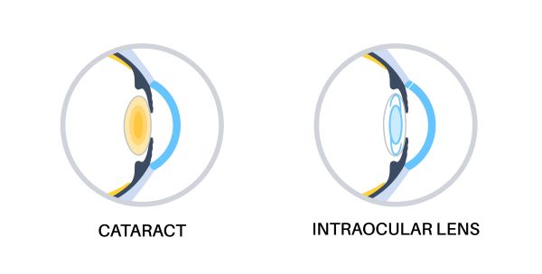IMPLANTE DE LENTE INTRAOCULAR EM CIRURGIA DE CATARATA
