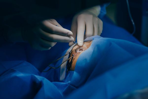 Cirurgia de transplante de córnea. 