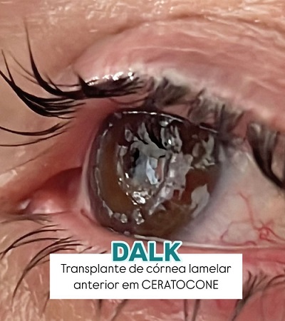 DALK - Transplante de Córnea Lamelar Anterior em Ceratocone.