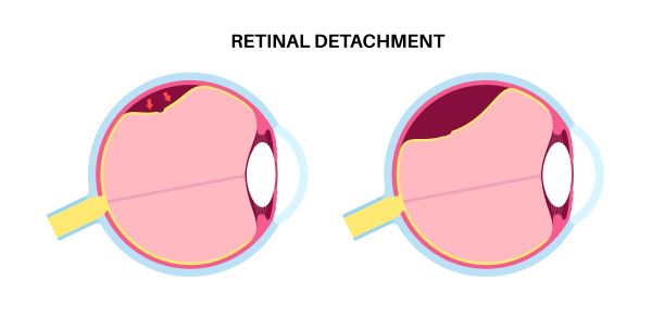 Descolamento de vítreo posterior