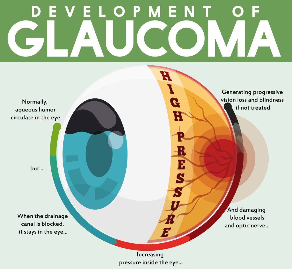 Vetor de um globo ocular apontando o desenvolvimento do glaucoma.