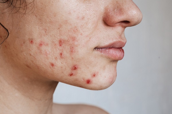 Close da parte inferior do rosto de uma jovem que apresenta a pele cheia de acne.