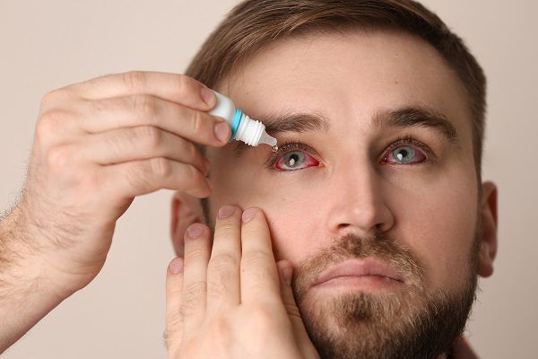 Homem com os olhos vermelhos, devido à conjuntivite vernal, aplica colírio.