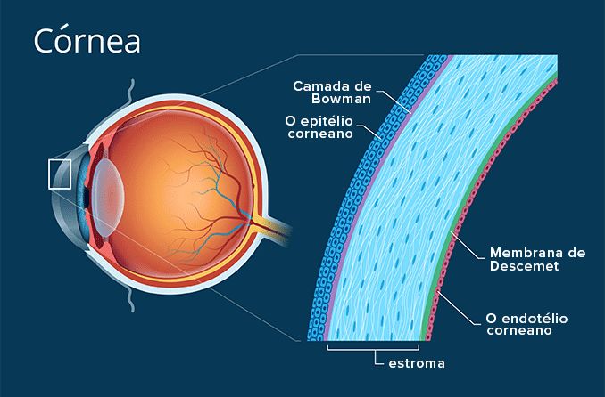 Imagem da córnea com destaque para : camada de Bowman. epitélio corneano, menbrana de Descemet, estroma e endotélio corneano.