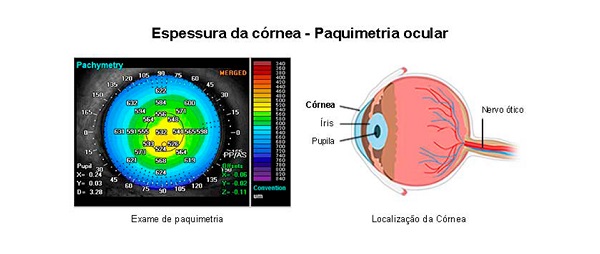 Paquimetria ocular é um dos exames utilizados para o diagnóstico da Distrofia Endotelial de Fuchs.
