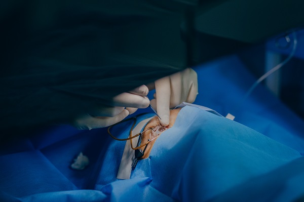 Cirurgia ocular: médico manipula instrumentos cirúrgicos em olho de paciente. 