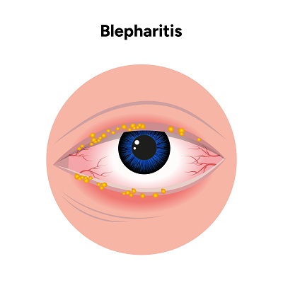Imagem em holograma demonstrando a infecção causada pelo virus do herpes simples - a blefarite herpética.