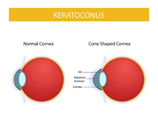 Imagem do globo ocular com destaque para representação de uma córnea normal e de outra com ceratocone avançado.