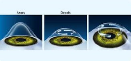 3 imagens do globo ocular: 
1 com ceratocone avançado;
2 com o anel intraestromal inserido;
3 visão superior do olho com o implante de anel .