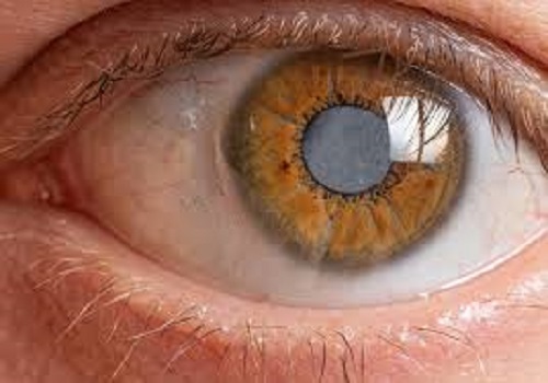 Olho castanho de um idoso, apresentando catarata.