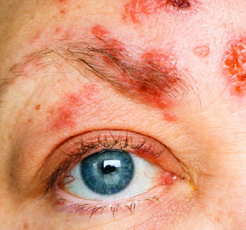 Rosto de uma mulher de olhos azuis, com muitas vesículas de herpes zóster próximas à região dos olhos.
