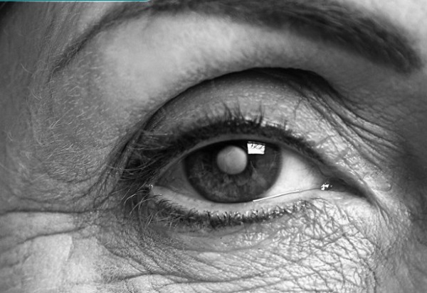 Close no olho com catarata.