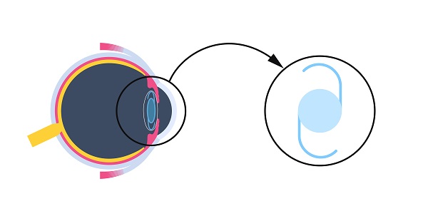 Ilustração representativa dos implantes de lentes intraoculares (LIOS)