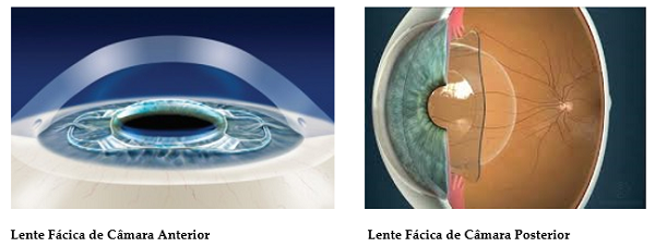 Ilustrações de implantes de lentes fácicas da câmera anterior (primeira) e câmera posterior (segunda)