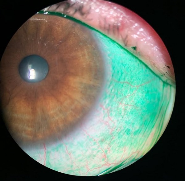 Ressecamento importante da superfície ocular, corando com lisamina verde, corante vital utilizado para avaliação do olho seco.