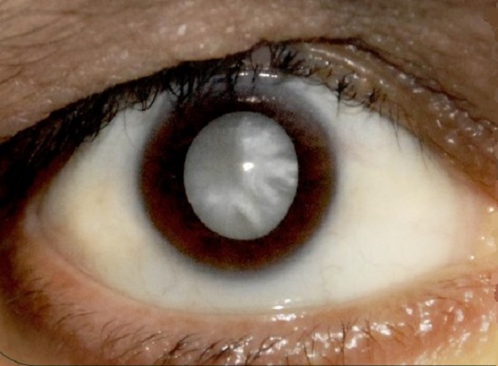 Olho com catarata avançada - embaçamento do cristalino é um dos sintomas da condição.