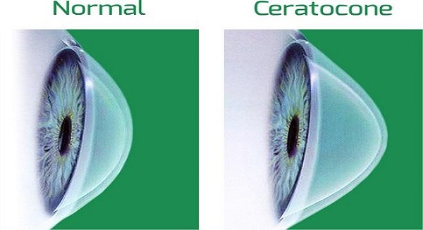 Figura demostrativa de uma córnea normal e de outra com ceratocone.
