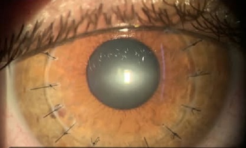 Transplante de córnea com a técnica DALK realizado pela Dra Terla em paciente com estágio avançado de ceratocone.