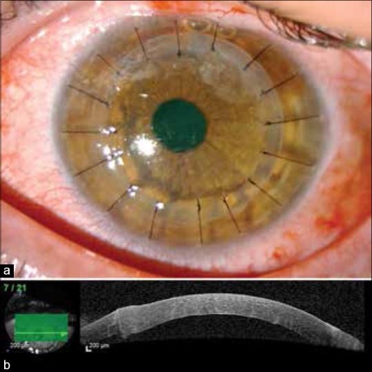 Ceratoplastia lamelar anterior profunda. 


