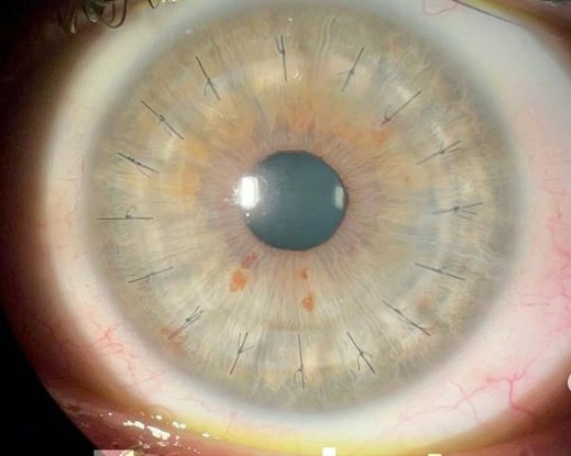 Close de um olho claro que passou por transplante lamelar anterior DALK.