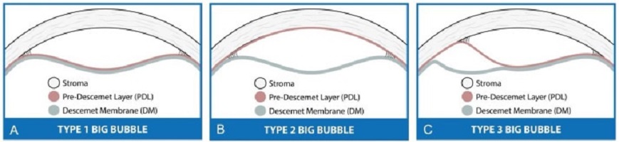 Técnica de transplante lamelar anterior com a técnica Big Bubble.