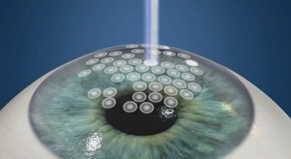 PTK - córnea recebendo feixes de laser de excímero para tratar irregularidades corneanas.