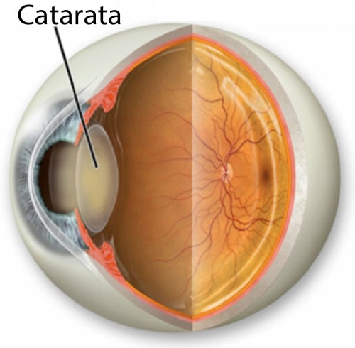 Globo ocular com cristalino opacificado pela catarata.
