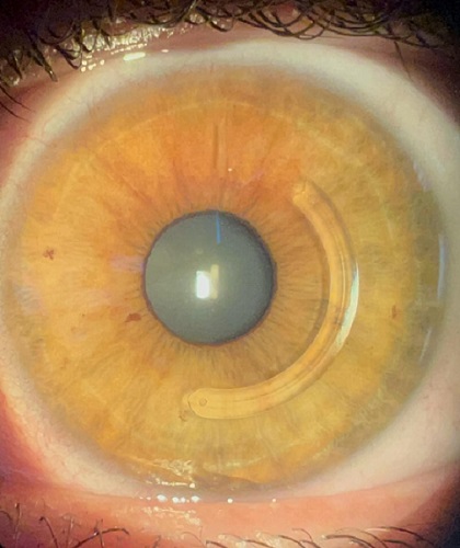Olho humano que passou por crosslinking corneano e Implante de anel intraestromal para tratamento do ceratocone.