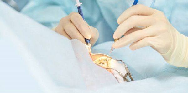 Cirurgia ocular em paciente com carcinoma conjuntival