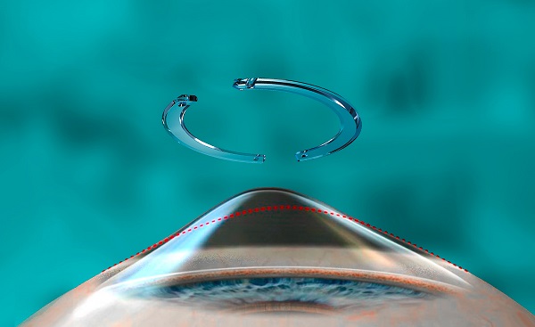 Imagem sugestiva de um olho com ceratocone recebendo o tratamento de crosslinking com implante de anel intracorneano.